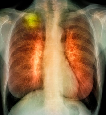 Lung cancer, X-ray