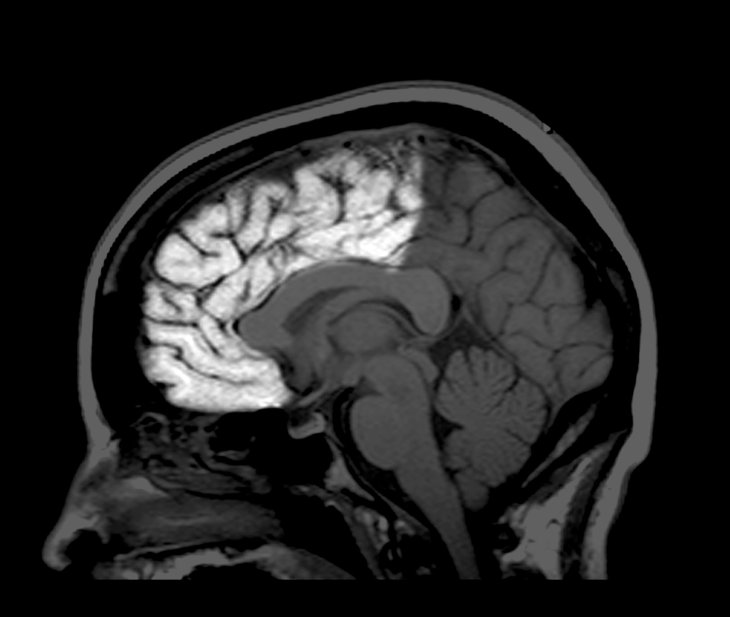 Un escáner MRI en el que se resalta el lóbulo frontal. A medida que las personas maduramos, el reformato del cerebro se ralentiza pero hasta los 30 años o más, aún se forman nuevos enlaces.