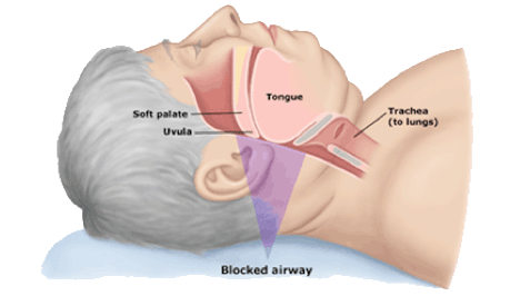 Obesidad y Apnea Del Sueño