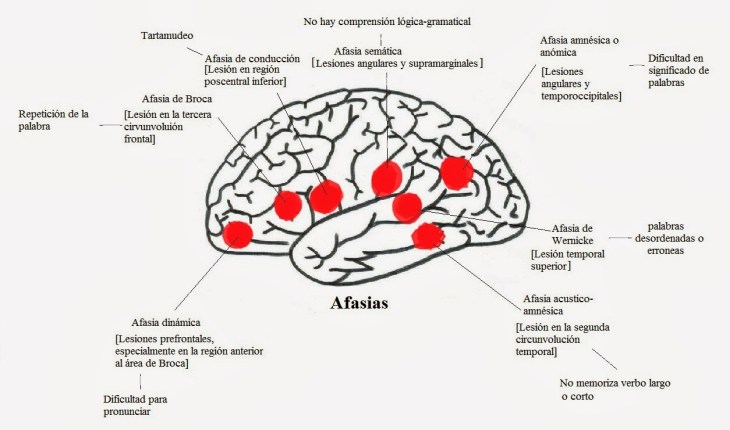 Tipos de Afasias